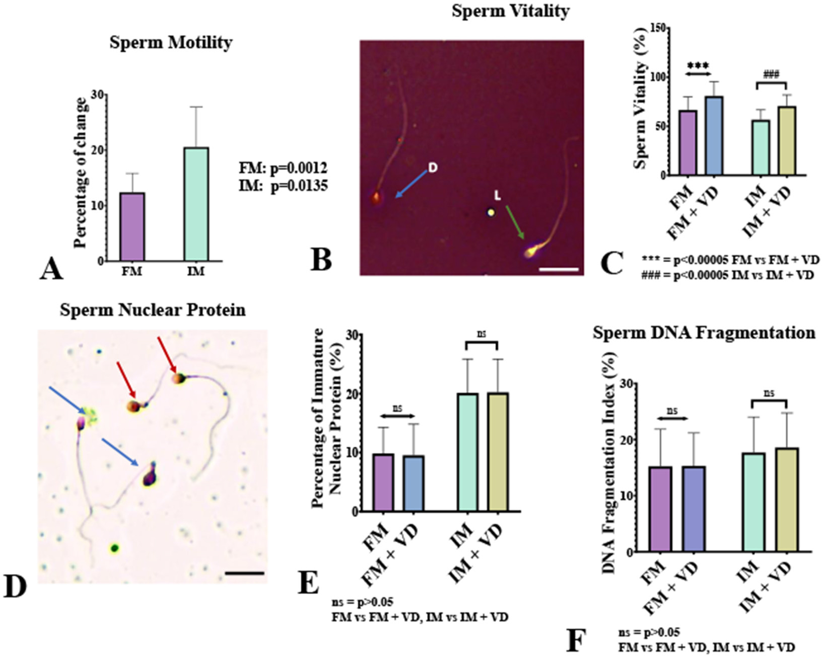 Basic Semen Analysis. A: Change in total sperm motility (%) in Fertile (FM) and Infertile Men (IM) after in vitro vitamin D treatment (p-values indicated). B: Eosin-Nigrosin staining showing sperm vitality; light blue arrows indicate dead sperm, and green arrows indicate live sperm. C: Percentage of live sperm in FM and IM with and without 1 nM vitamin D treatment (statistical significance from paired t-test). D: Aniline blue staining revealing nuclear protein; mature sperm heads are marked with red arrows, and immature heads with purple arrows. E: Percentage of immature nuclear protein for FM and IM with and without in vitro vitamin D treatment (paired t-test). F: DNA Fragmentation Index (DFI) percentages for FM and IM with and without in vitro vitamin D treatment (paired t-test). Values are mean±SEM, n=20. Magnification: 40X, Scale bar: 100 µm. Abbreviations: FM=Fertile men; FM + VD=Fertile men with in vitro vitamin D treatment; IM=Infertile men; IM + VD=Infertile men with in vitro vitamin D treatment.