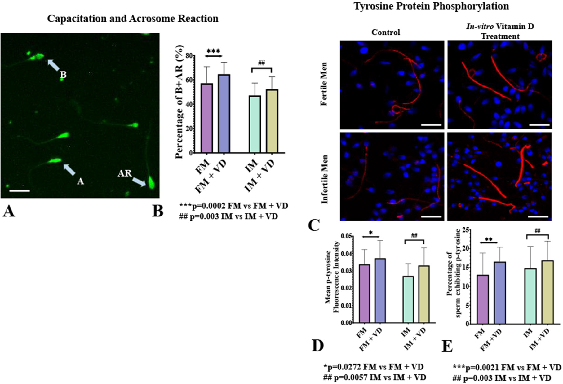 Sperm Capacitation. A: Assessment of sperm capacitation and acrosome reaction using Chlortetracycline (CTC) staining. Capacitated Acrosome-Reacted sperm (AR) exhibit dull fluorescence over the head and bright fluorescence in the midpiece, while intact sperm show uniform fluorescence. B: Bar chart showing the percentage of capacitated and acrosome-reacted sperm in Fertile (FM) and Infertile Men (IM) with and without 1 nM vitamin D treatment (paired t-test). C: Immunofluorescence of phospho-tyrosine in sperm; red indicates tyrosine phosphorylation, blue marks the nucleus. D: Bar chart showing Corrected Total Cell Fluorescence (CTCF) of phospho-tyrosine in sperm from FM and IM with and without in vitro vitamin D treatment (paired t-test). E: Bar chart showing the percentage of sperm exhibiting phospho-tyrosine in FM and IM with and without vitamin D treatment (paired t-test). Values are mean±SD, n=20. Magnification: 40X, Scale bar: 100 µm. Abbreviations: FM=Fertile men; FM + VD=Fertile men with in vitro vitamin D treatment; IM=Infertile men; IM + VD=Infertile men with in vitro vitamin D treatment.