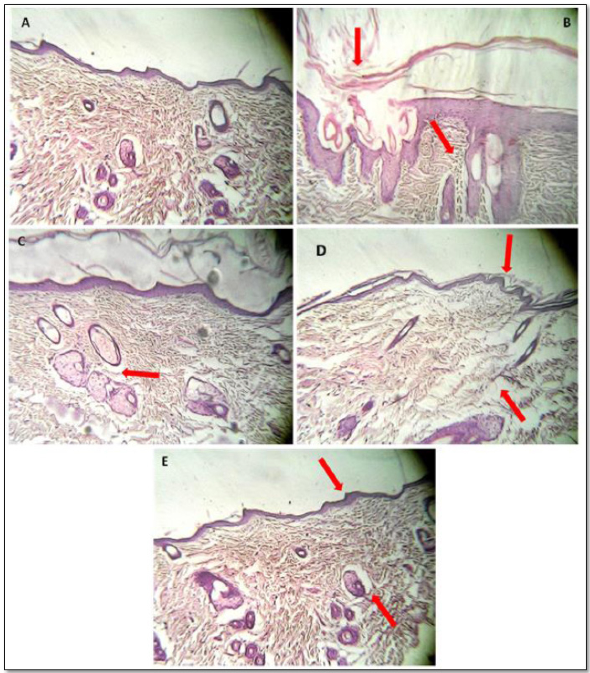 Antipsoriatic effect of phyllanthin ointment on histopathological changes in the skin induced by imiquimod in rats. A: Vehicle control, B: Disease control, C: Positive control, D: FIII (phyllanthin 1%) and E: FIII* (phyllanthin 2%).