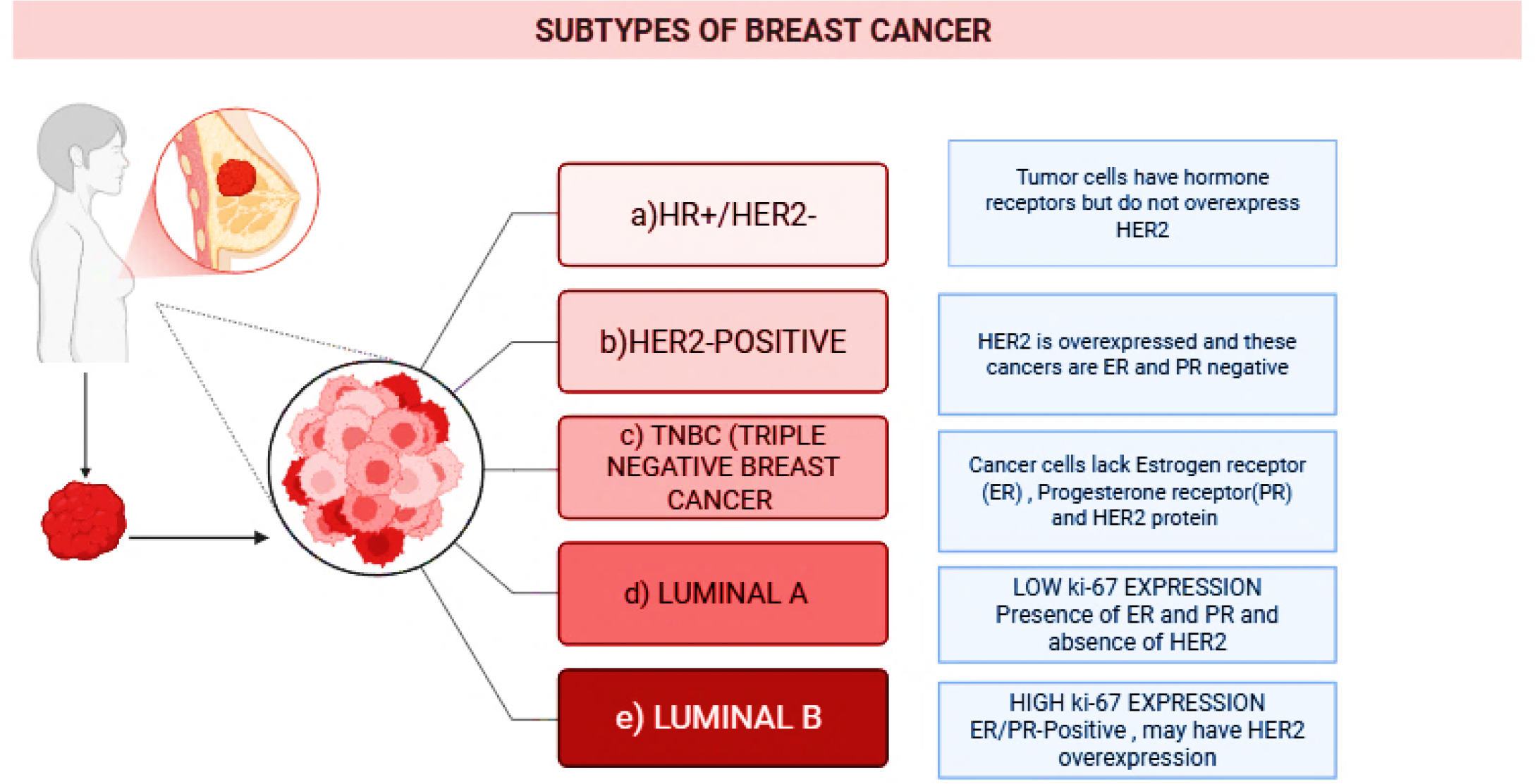 Classification of breast cancer into major molecular subtypes based on hormone receptor (ER/PR) & HER2 expression. These subtypes reflect distinct biological behaviors & guide prognosis & targeted therapeutic strategies (Inic et al., 2014).