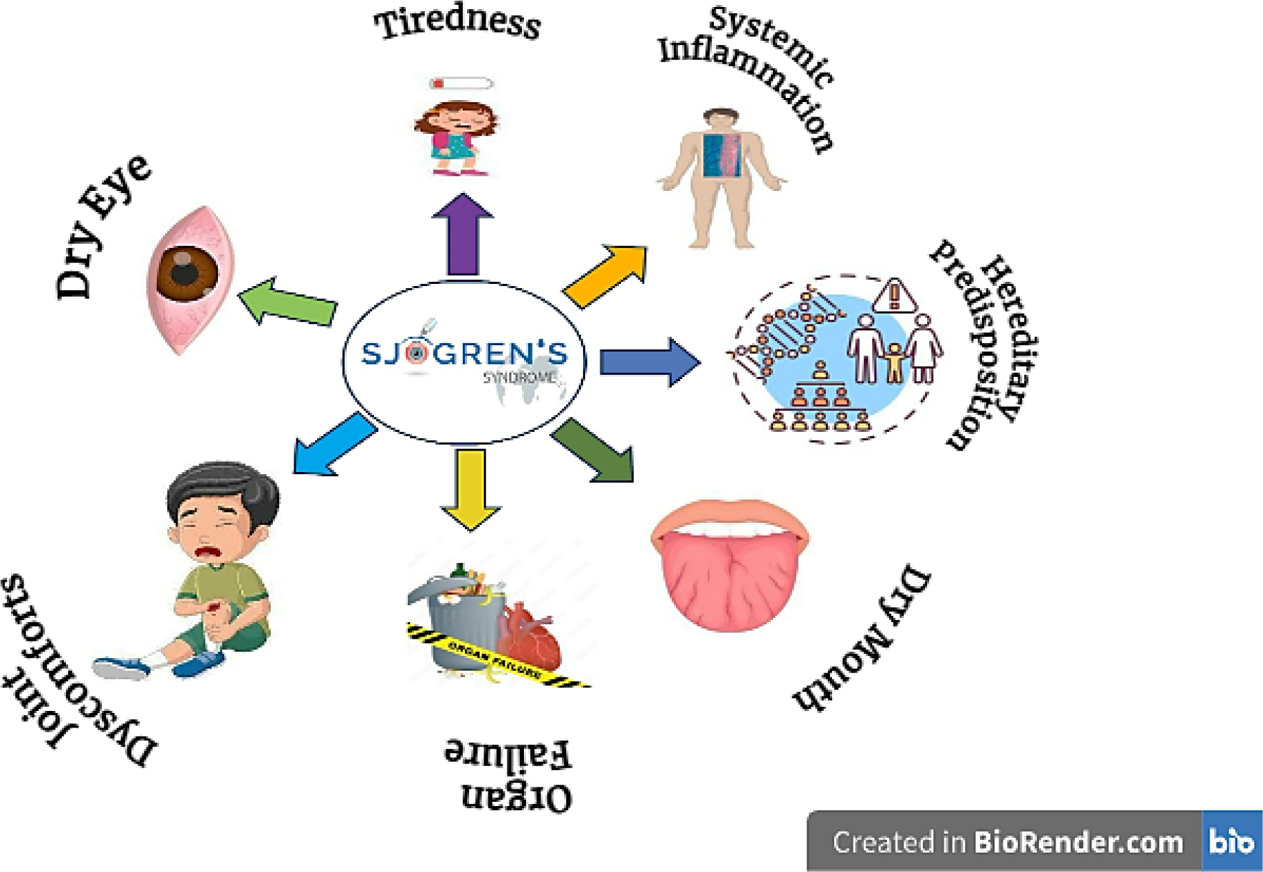 Insights on Sjögren’s Syndrome: Beyond Dry Eye Symptoms Insights on Sjögren’s Syndrome: Beyond Dry Eye Symptoms