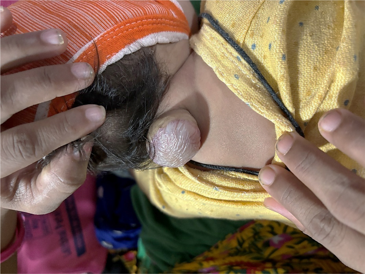Cervical Myelomeningocele: A Rare Neural Tube Defect: A Case Report Cervical Myelomeningocele: A Rare Neural Tube Defect: A Case Report