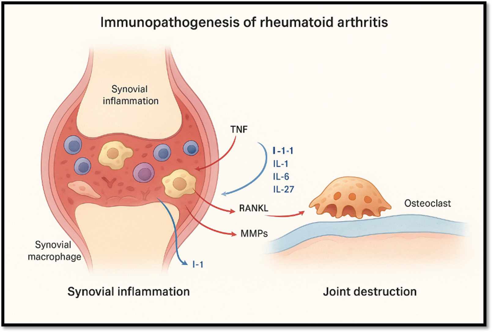 Immunopathogenesis of Rheumatoid Arthritis.