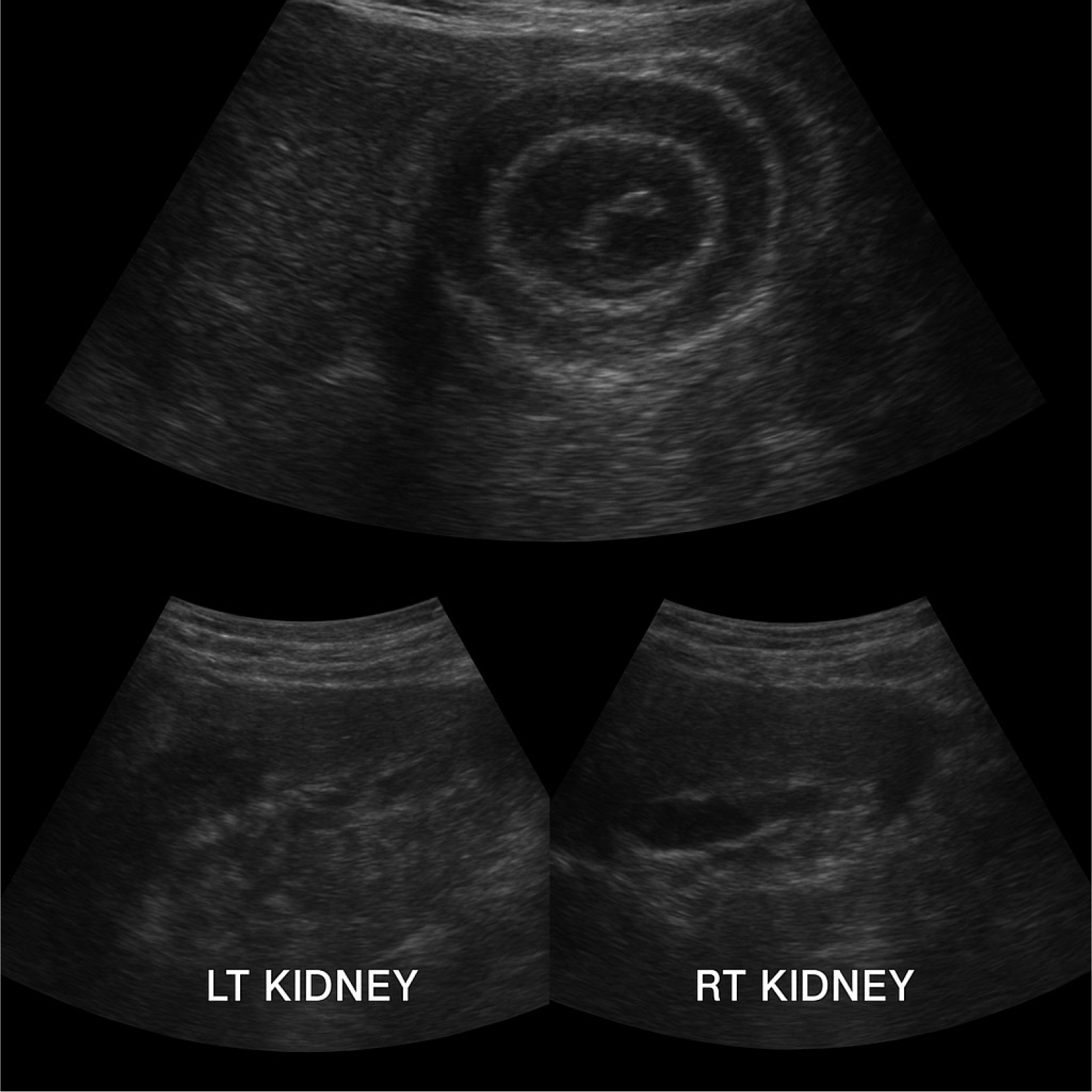 Ultrasound image of left and right kidney.