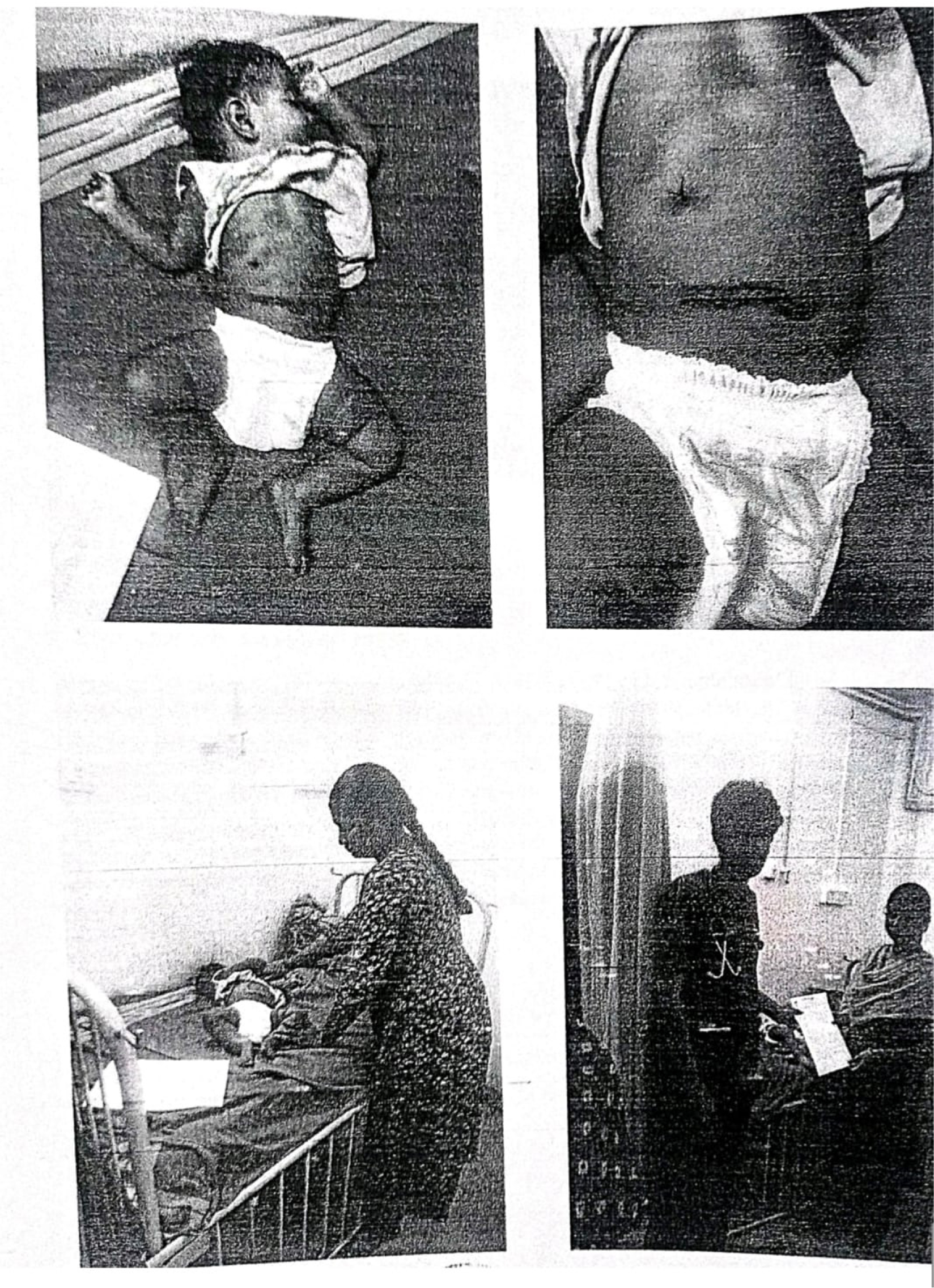 Postoperative image showing the healed transverse incision site following manual reduction of ileocolic intussusception.