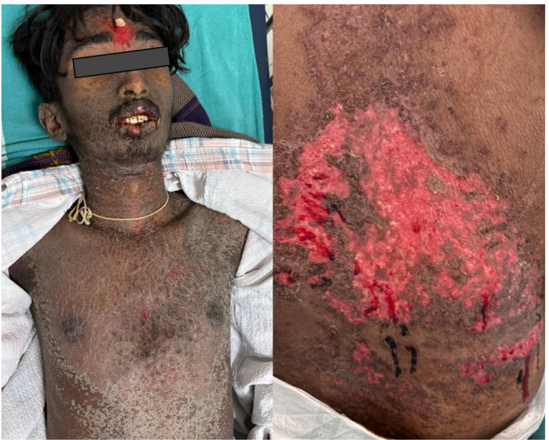 Generalised erythema and scaling with hemorrhagic lip crusting and areas of epidermal detachment.