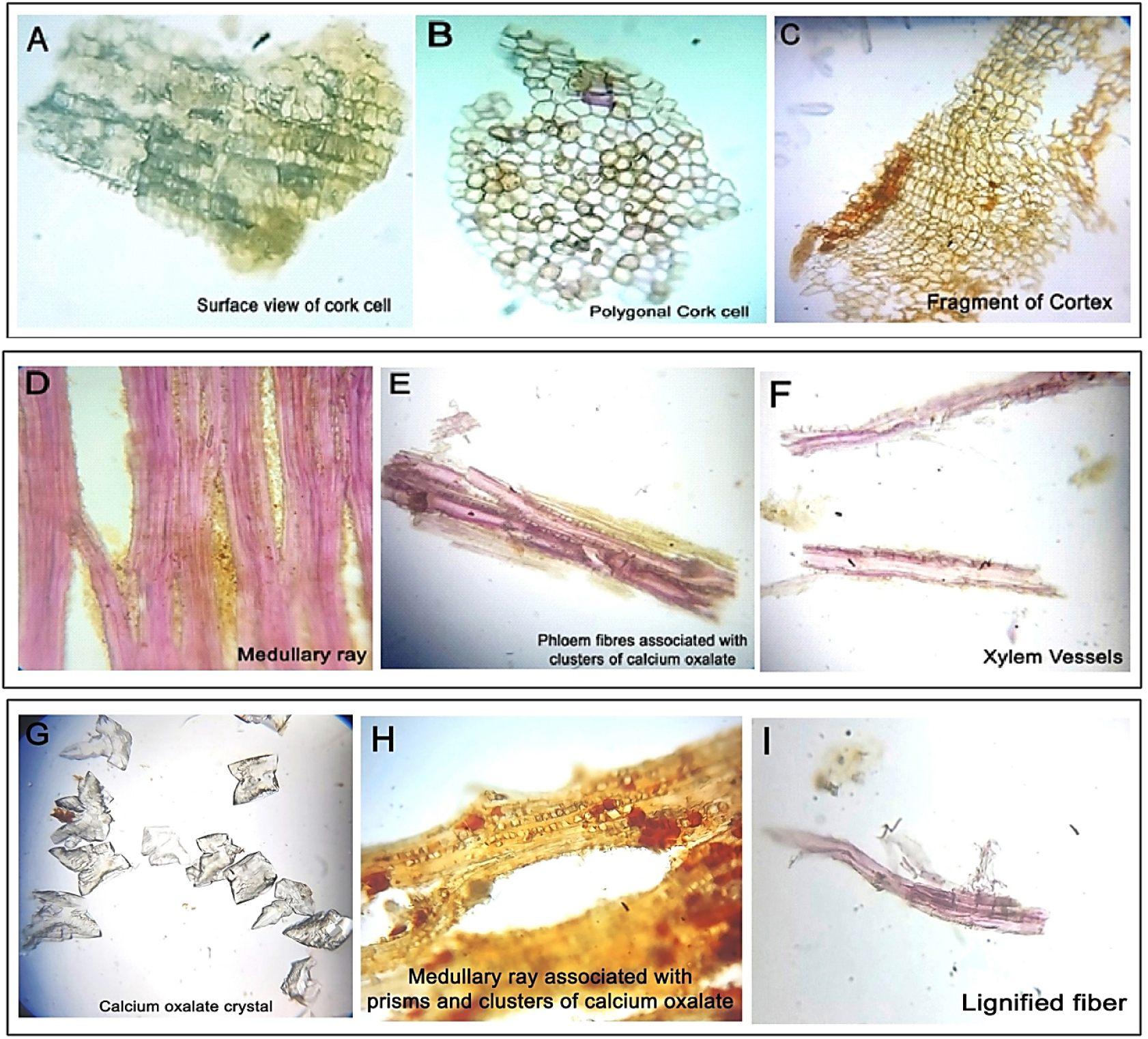 Powdered Microscopic view of the stem bark of Soymida febrifuga (Roxb.) A. Juss. (A) Cork cell surface view (B) Cork cell fragments (C) Fragments of cortex (D) Medullary ray (E) Phloem fiber with calcium oxalate crystal (F) Xylem vessels (G) Group of calcium oxalate crystal (H) Medullary ray with calcium oxalate crystal (I) Lignified fiber.