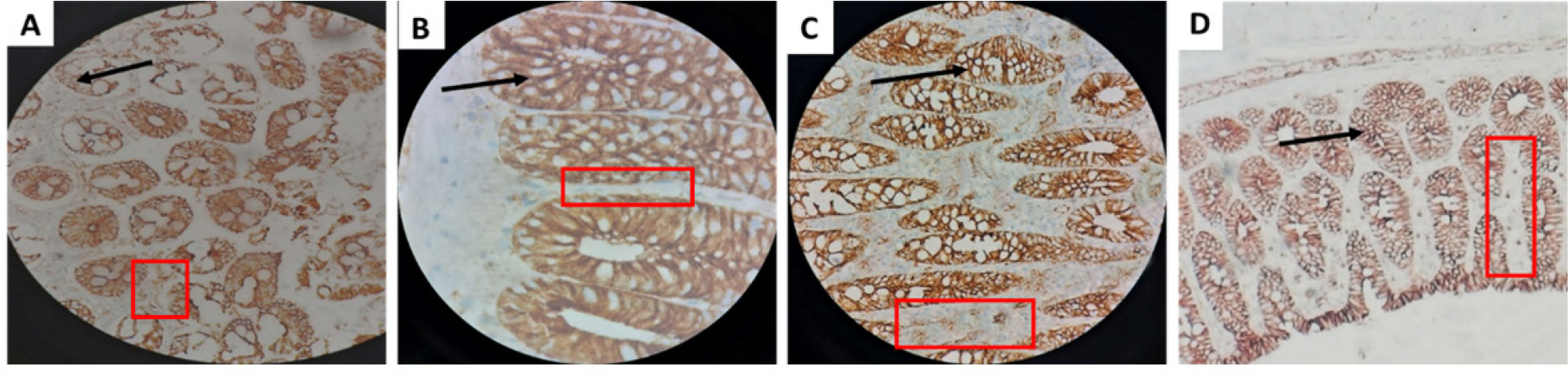 Immunohistochemical staining of β-catenin in colon tissue sections (40×). The disease control group (DMH + HFD) shows prominent nuclear and cytoplasmic accumulation of β-catenin, indicating enhanced proliferative signaling. Treatment with kefir and Methanolic Leaf Extract of Citrullus colocynthis (MLECC) restored predominant membranous localization, reflecting suppression of Wnt/β-catenin activation. Black arrows indicate β-catenin localization, and red boxes highlight preservation of cell junction integrity.