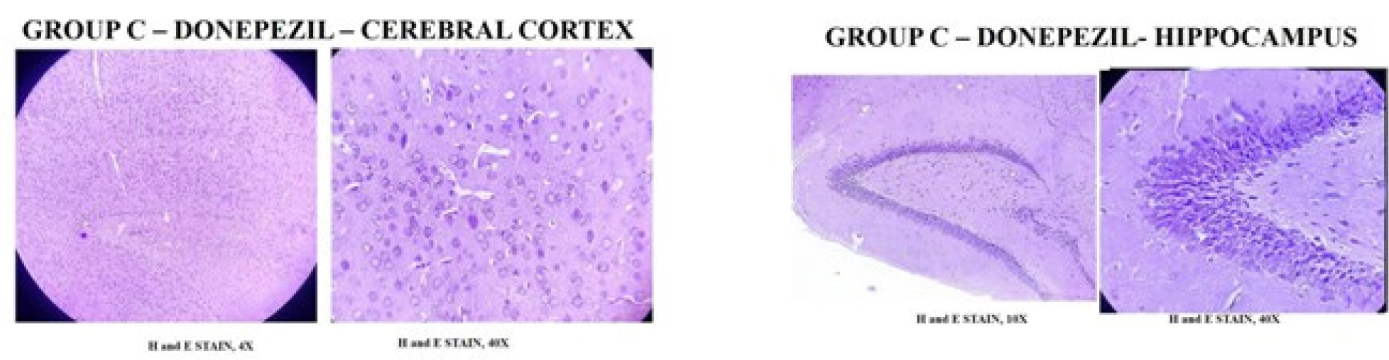 Group III - AlCl3 (17 mg/kg/p.o) + Donepezil hydrochloride (3 mg/kg, p.o.). H and E stained section shows densely packed granular cells in dentate gyrus,vacuolation below granular layer is not seen. The thickness of hippocampus proper is almost normal. Granular cells, pyramidal cells, blood vessels are noted with perivascular edema at very few places.