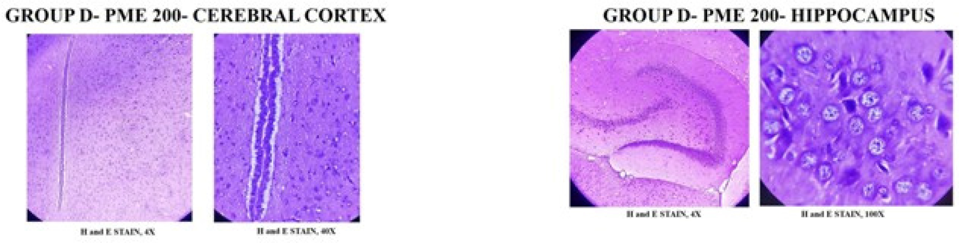 Group IV - AlCl3 (17 mg/kg/p.o) + CFPMB (200 mg/kg, p.o). H and E stained section shows brain with hippocampus proper and dentate gyrus. No vacuolated cells below the granular layer are seen. Perivascular edema with congested blood vessels, vacuolated cells, neuronal shrinkage are observed at few places.