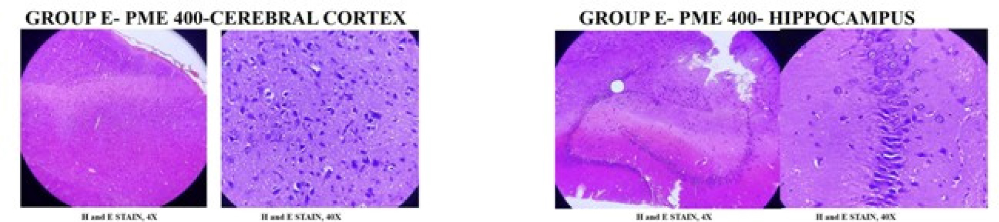 Group V- AlCl3 (17 mg/kg/p.o) + CFPMB (400 mg/kg, p.o). H and E stained section shows brain with slightly reduced thickness in hippocampus region. Lateral ventricles are normal in size. No vacuolation in dentate gyrus region. Cerebral cortex is normal with pyramidal cells, granular cells and blood vessels.