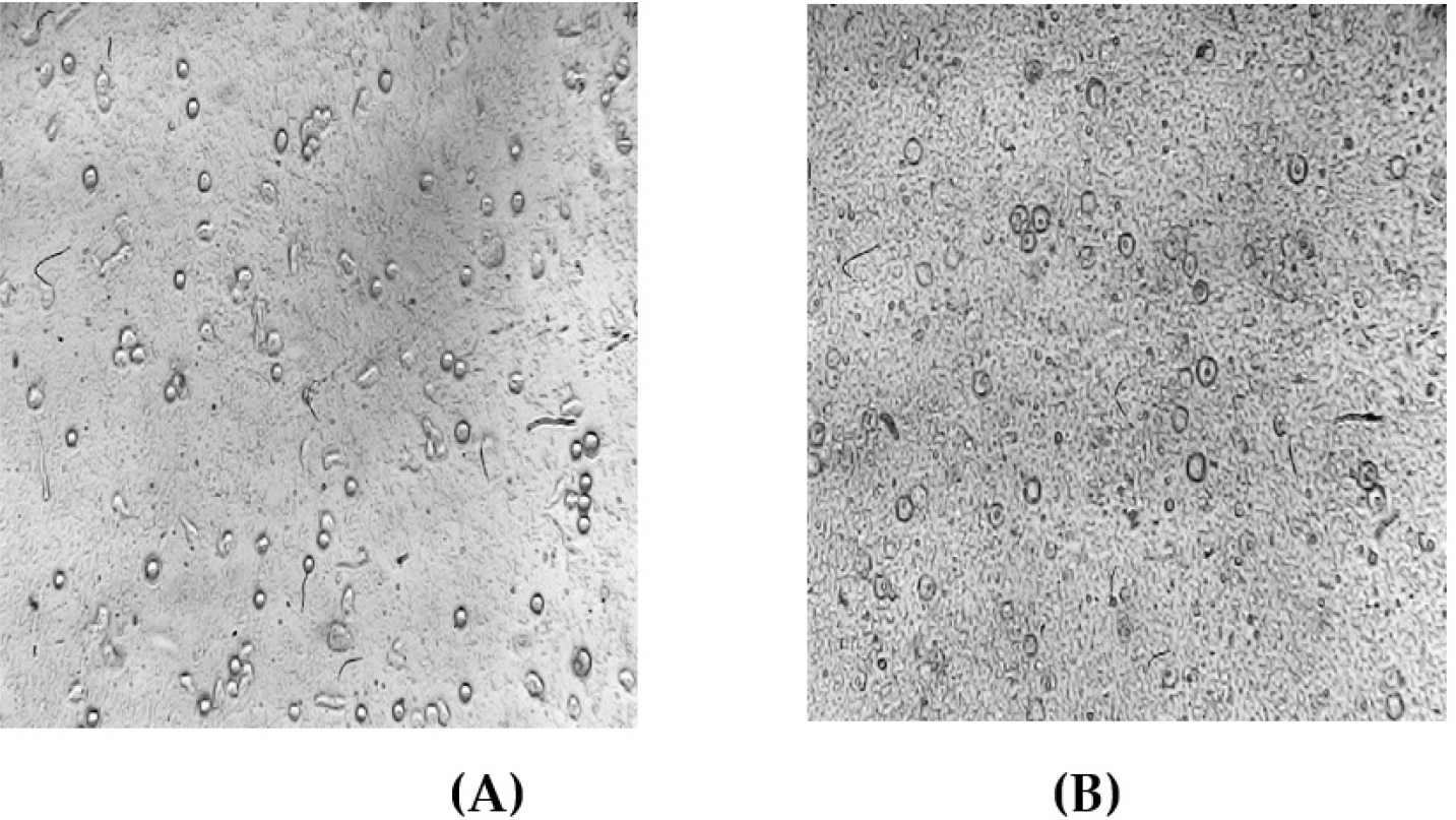 Morphological changes in Hep G2 (Liver Cancer) cells. (A) Untreated control cells. (B) Cells treated with Swarnavari Bhasma (100 µL/mL).